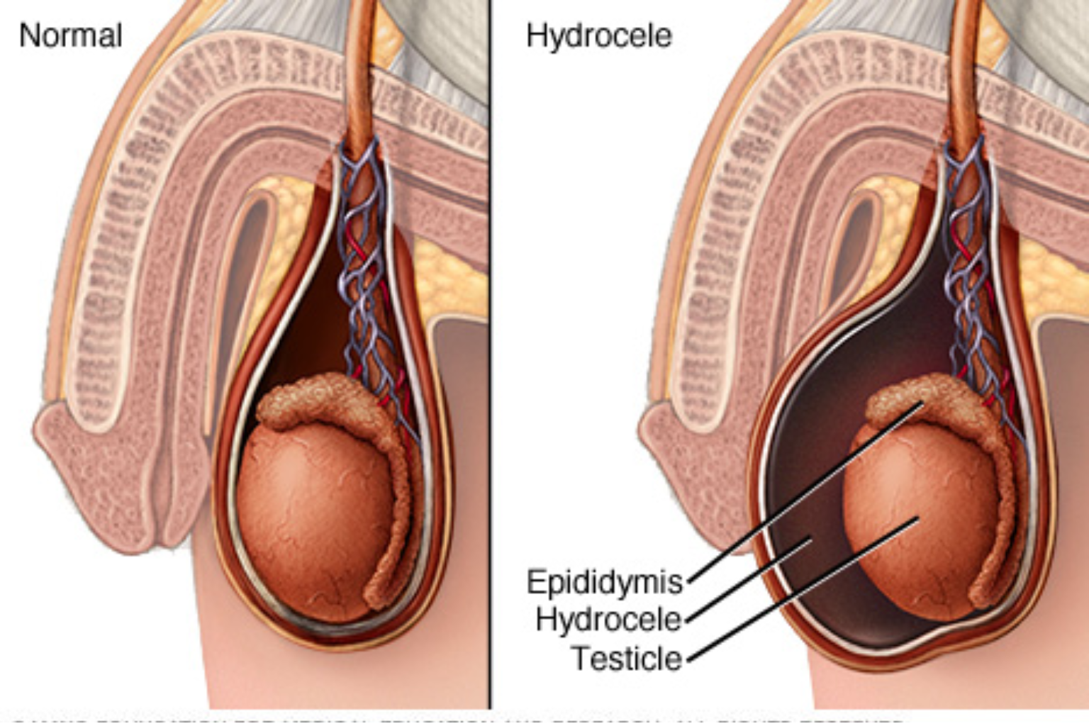 Hydrocele & Phimosis (हाइड्रोसील) treatment at Manglam Hospital, Narnaul