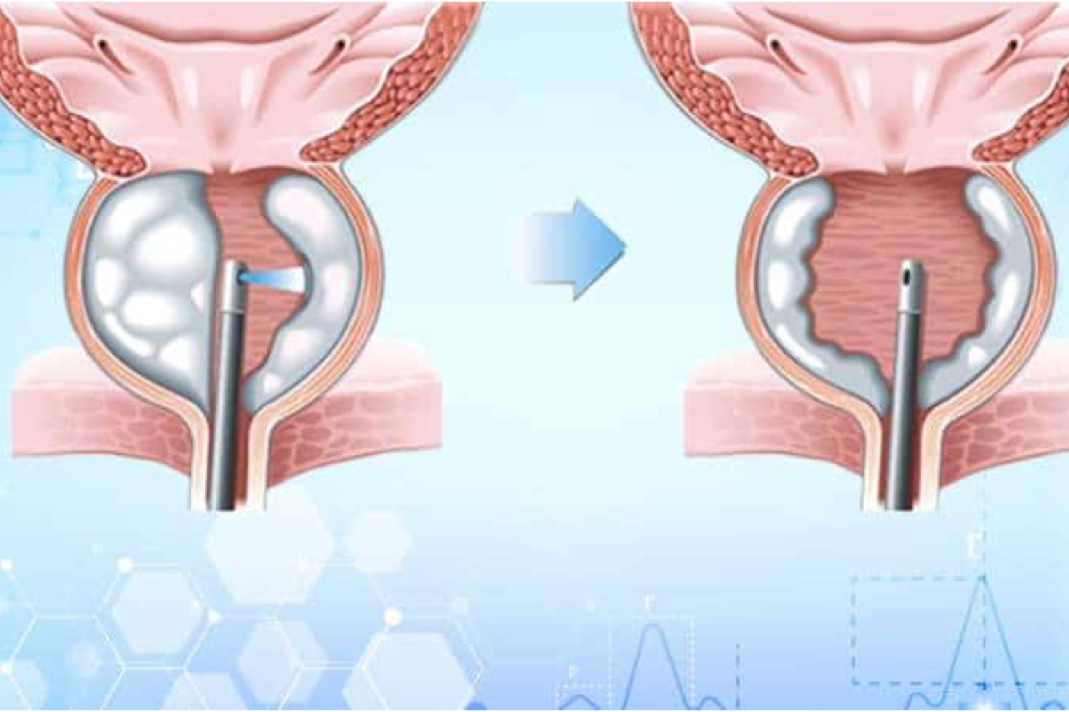 Prostate Care (प्रोस्टेट गदूद) treatment at Manglam Hospital, Narnaul